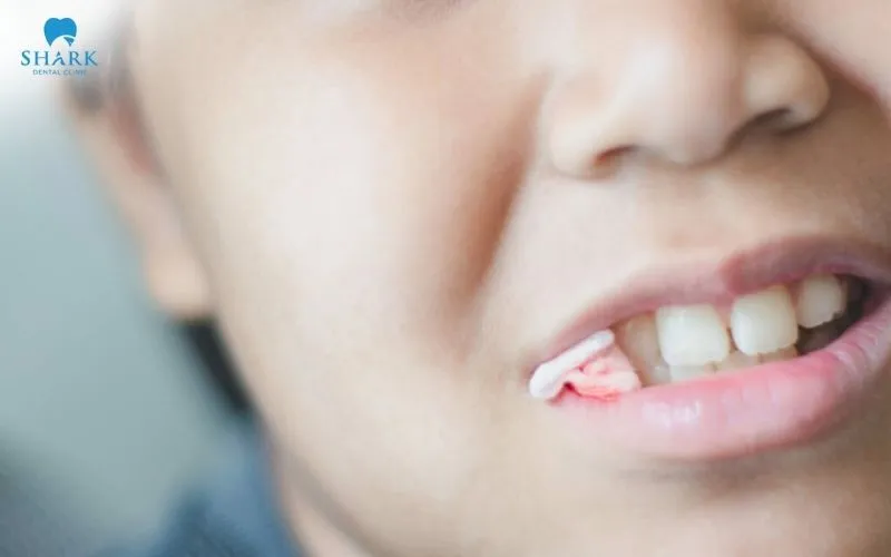 Mẹo cầm máu sau khi nhổ răng khôn đúng cách và an toàn 10 Sau khi nhổ răng khôn, máu sẽ giảm dần và cơ bản được kiểm soát sau khoảng 30 - 60 phút nếu cắn gạc đúng theo hướng dẫn của bác sĩ
