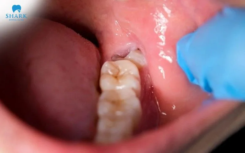 Răng khôn, hay răng số 8, thường bắt đầu mọc trong khoảng từ 17 - 25 tuổi