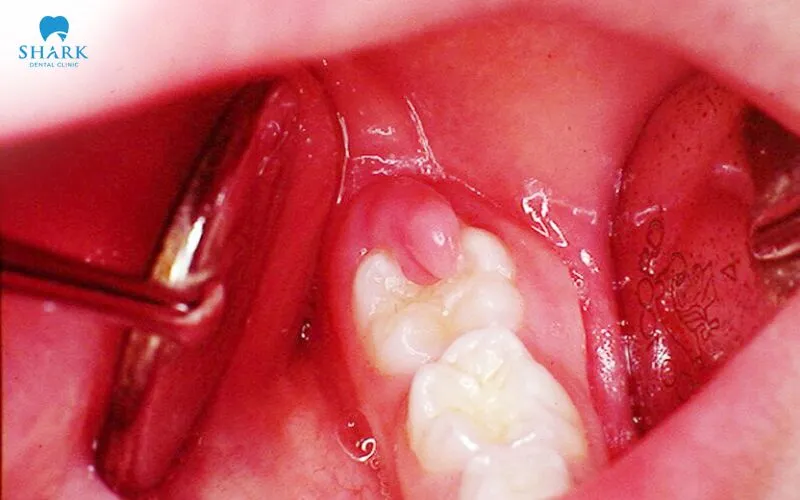 Khi răng khôn xuyên qua phần nướu đã ổn định, vùng nước phía sau hàm có thể sưng đỏ, đau và nhạy cảm