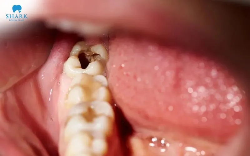 Khi răng khôn bị sâu hoặc mắc các bệnh lý, chiếc răng này cần được nhổ bỏ để đảm bảo an toàn cho sức khỏe