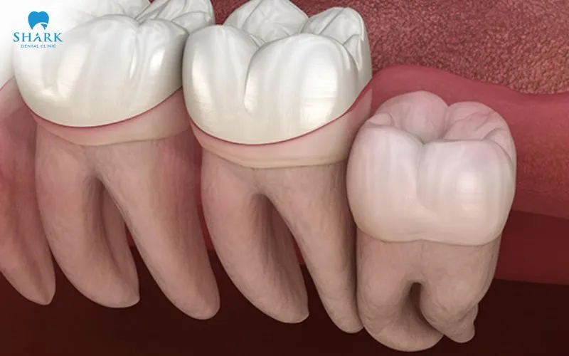 Răng khôn mọc thẳng, phát triển bình thường và không gây đau đớn thì sẽ không cần loại bỏ 