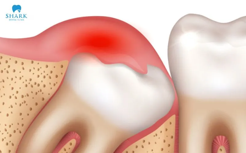 Viêm lợi trùm gây sưng đau vùng lợi và khiến bạn cảm thấy đau hoặc khó chịu khi nuốt nước bọt