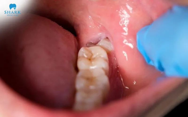 Răng khôn mọc nghiêng về phía răng số 7 có thể tạo áp lực lên răng kế cận, gây đau nhức và dễ phát sinh viêm nhiễm