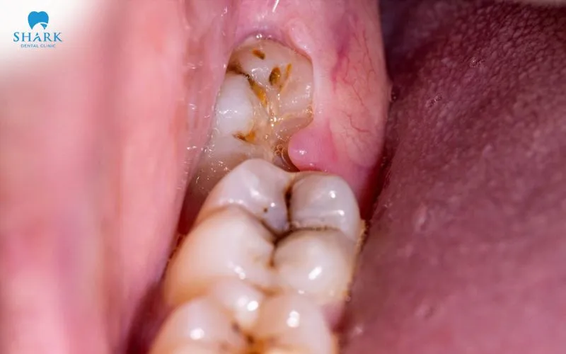 Biến chứng điển hình khi răng khôn mọc có thể gây viêm lợi trùm và hình thành ổ mủ