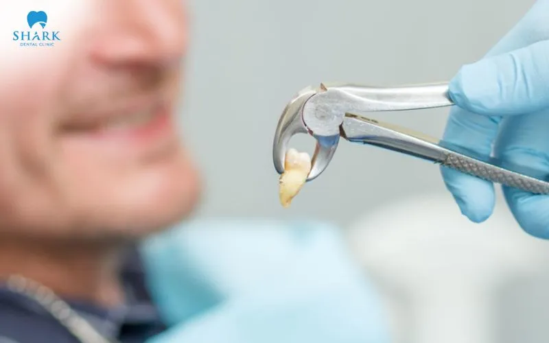 Sau khi nhổ răng khôn, cơ thể sẽ cần một khoảng thời gian để phục hồi mô nướu và xương tại vị trí vừa can thiệp