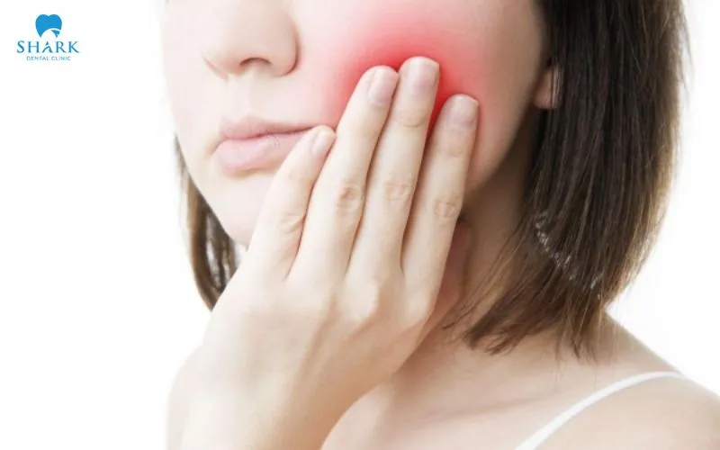 Nhổ răng khôn bị sưng có sao không? Sưng bao lâu thì hết? 8 Tình trạng sưng sau khi nhổ răng khôn kéo dài khoảng 7-10 ngày và giảm dần khi vết thương hồi phục