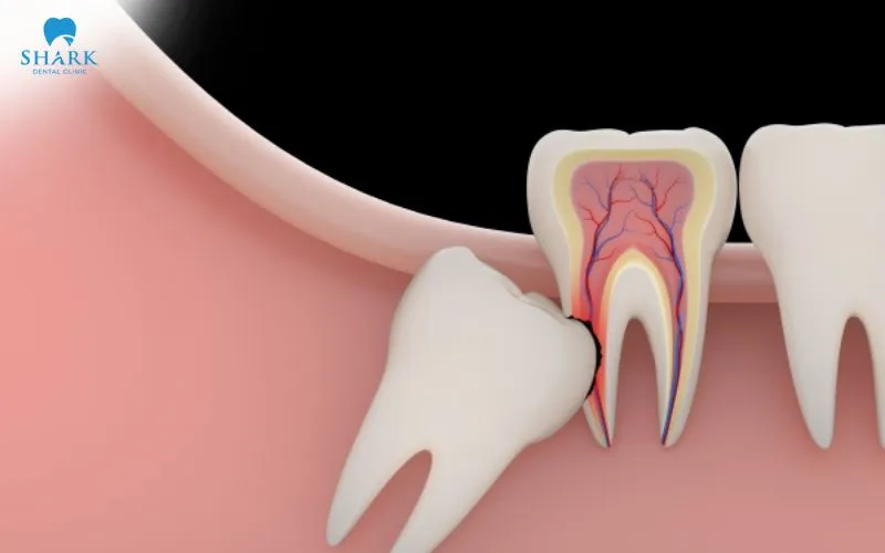 Răng khôn mọc lệch, mọc ngầm hoặc bị kẹt có thể gây đau, viêm nướu, u nang và nhiễm trùng tái diễn là những trường hợp bạn nên nhổ răng