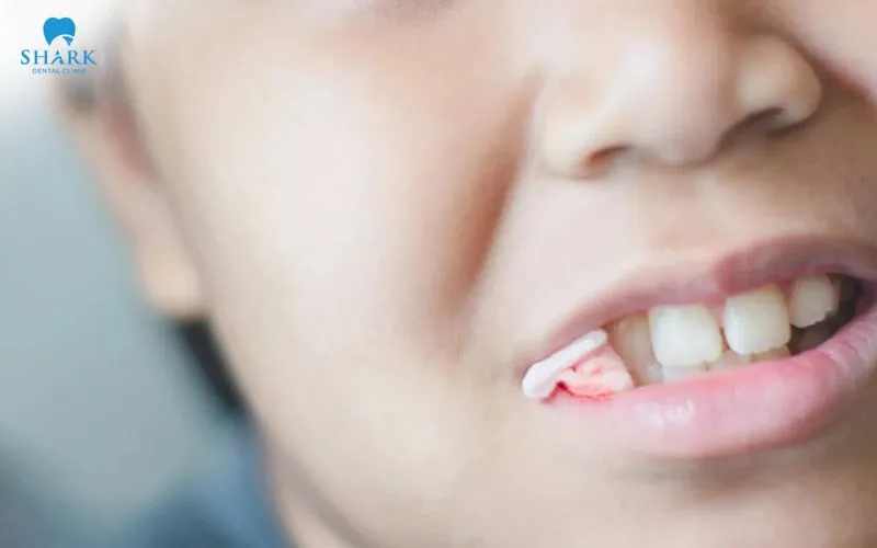 Sau khi nhổ răng, bạn nên cắn gạc theo đúng thời gian bác sĩ hướng dẫn để hỗ trợ cầm máu và bảo vệ cục máu đông trong ổ răng