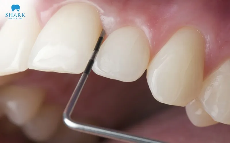 Niềng răng không nhổ răng có hiệu quả không? 14 IPR là kỹ thuật giúp loại bỏ một lượng rất nhỏ men răng ở mặt tiếp xúc giữa các răng để tạo thêm khoảng trống phục vụ quá trình sắp xếp răng