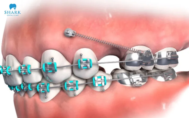 Niềng răng không nhổ răng có hiệu quả không? 15 Minivis chỉnh nha là những vít nhỏ được đặt vào xương hàm để tạo điểm neo cố định cho răng