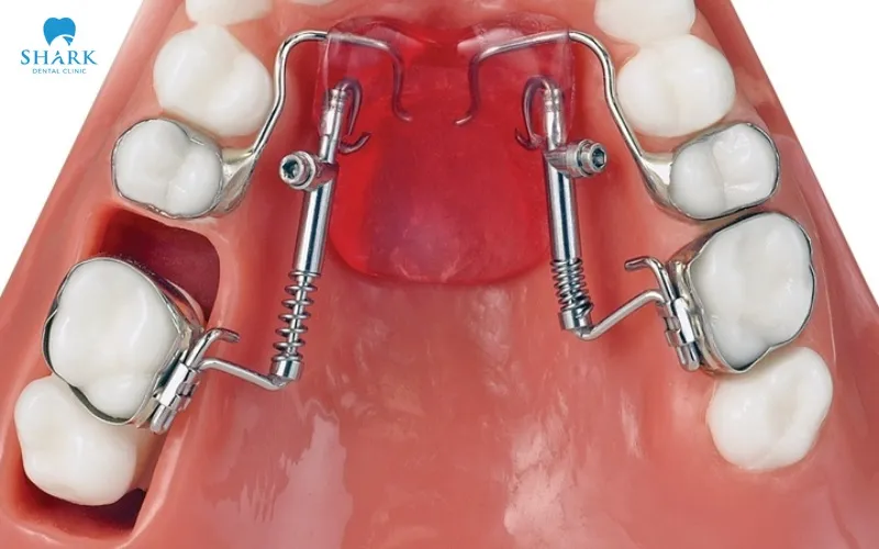 Niềng răng không nhổ răng có hiệu quả không? 16 Di xa toàn hàm là kỹ thuật dịch chuyển các nhóm răng về phía sau trên cung hàm nhằm tạo thêm khoảng để sắp xếp răng mà không cần nhổ răng