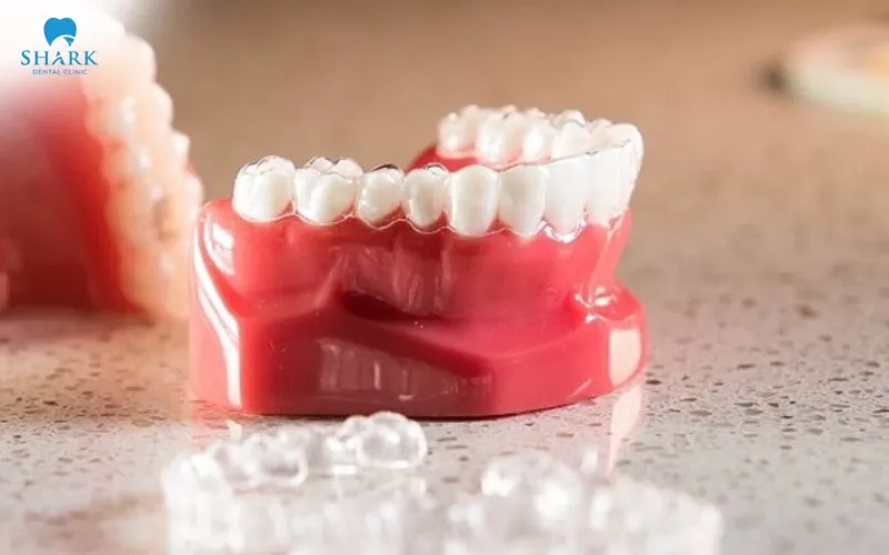 Chi phí niềng răng bằng khay trong suốt hiện nay thường dao động linh hoạt và sẽ khác nhau tùy vào thương hiệu và mức độ sai lệch răng của từng trường hợp