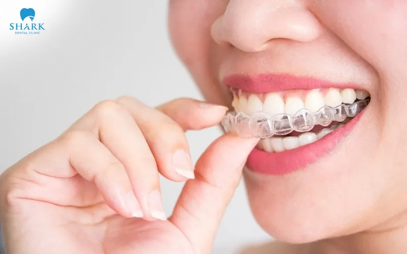 Chi phí niềng răng thường không cố định mà có thể thay đổi tùy vào khí cụ, số lượng khay và tính trạng răng miệng thực tế