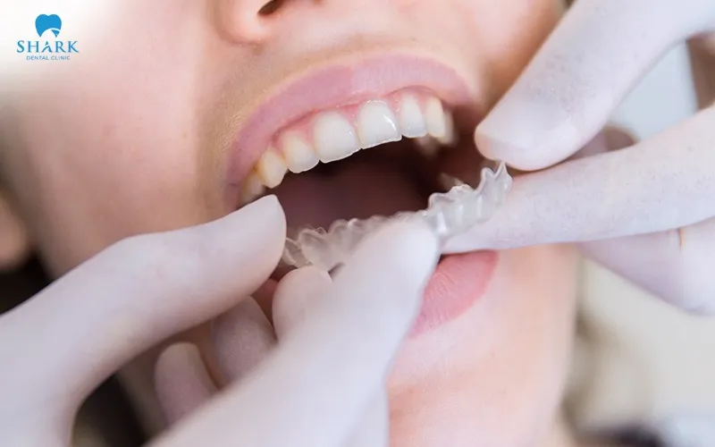 Sau khi thực hiện, bạn cần tái khám đúng hẹn để bác sĩ kiểm tra tiến độ dịch chuyển của răng, đồng thời theo dõi quá trình điều trị theo kế hoạch