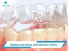 Niềng răng trong suốt giá bao nhiêu? Bảng giá chi tiết từng loại