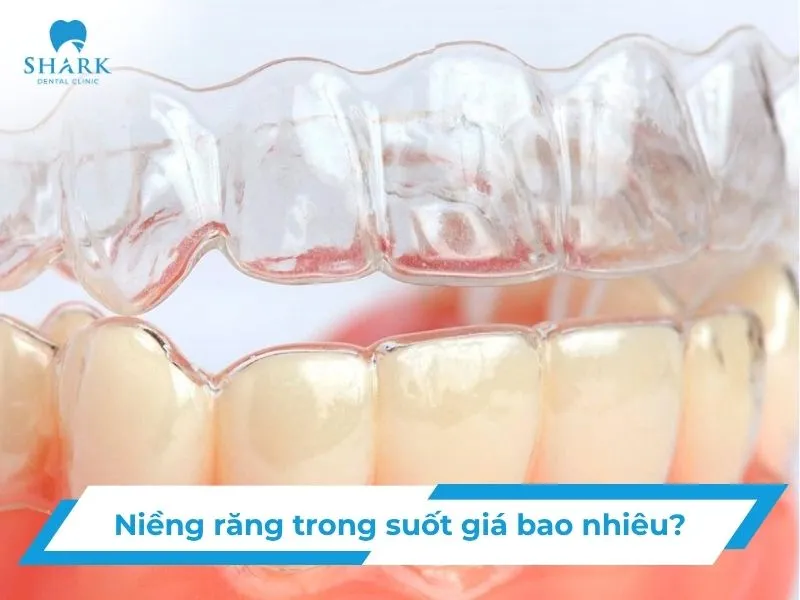 Niềng răng trong suốt giá bao nhiêu? Bảng giá chi tiết từng loại