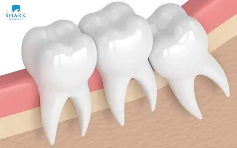 Răng khôn bị sâu có trám được không? Nên trám hay nhổ 10 Răng khôn mọc lệch có thể gây ra tình trạng sâu răng