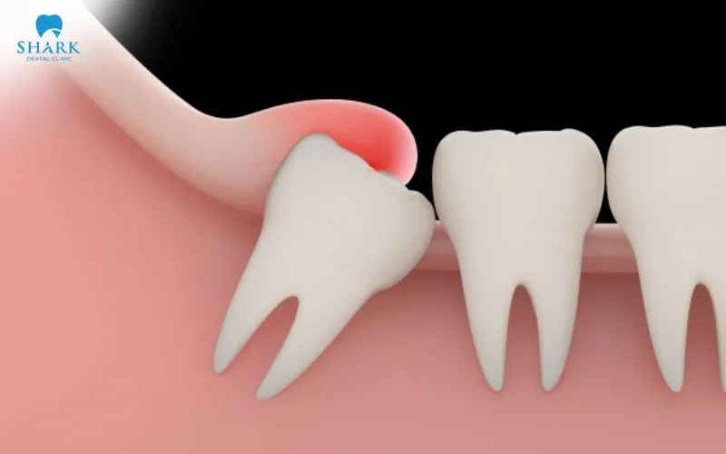 Răng khôn bị sâu có trám được không? Nên trám hay nhổ 12 Răng khôn mọc sẽ gây tình trạng sưng nướu từ đó cản trở việc vệ sinh răng miệng gây cảm giác khó chịu