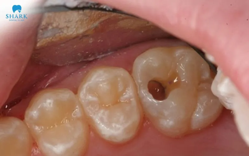 Răng khôn bị sâu có trám được không? Nên trám hay nhổ 13 Răng khôn mọc thẳng và bị sâu nhẹ có thể được thực hiện phục hồi bằng vật liệu trám