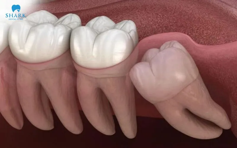 Răng khôn bị sâu có trám được không? Nên trám hay nhổ 14 Những chiếc răng khôn mọc ngầm, mọc lệch đâm vào răng số 7 thường không được khuyến khích trám mà cần được loại bỏ nhằm tránh ảnh hưởng