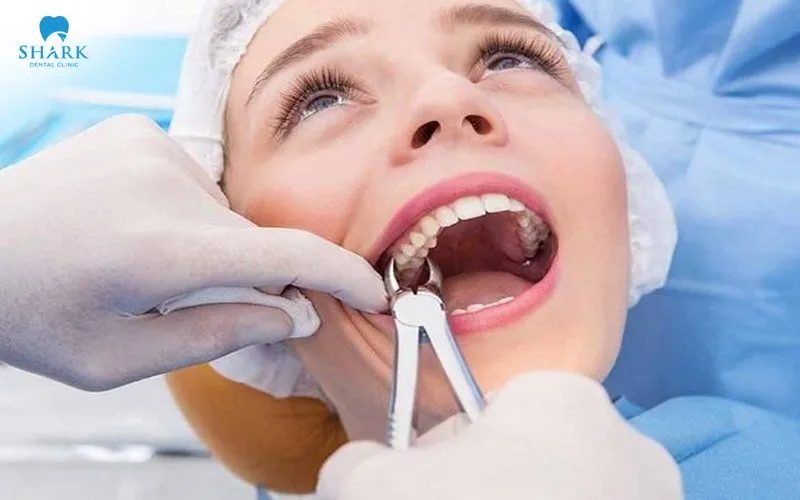 Tiểu phẫu răng khôn là thủ thuật nha khoa được thực hiện để loại bỏ răng số 8 mọc lệch, mọc ngầm hoặc có cấu trúc phức tạp