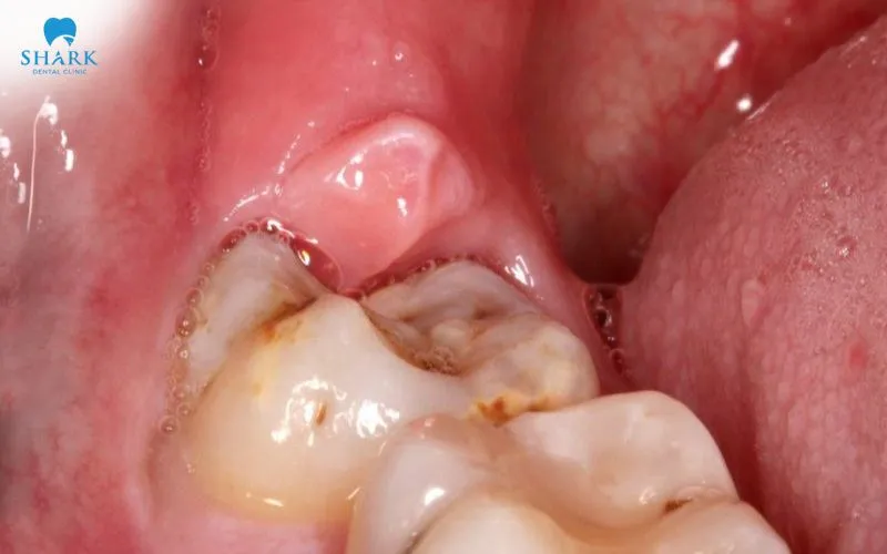 Răng khôn mọc bất thường có thể liên quan đến một số biến chứng khác ở vùng hàm như u nang quanh răng, áp xe,...