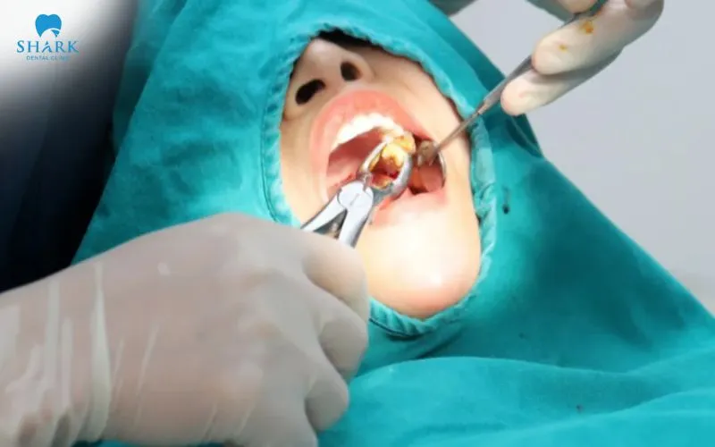 Kỹ thuật này thường không gây đau trong quá trình thực hiện vì được gây tê tại vùng răng cần nhổ