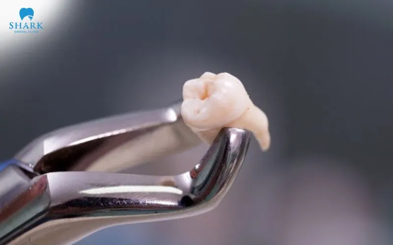 Chi phí tiểu phẫu hiện dao động khoảng 900.000 - 5.000.000 VNĐ/răng, tuỳ theo mức độ từ đơn giản đến phức tạp