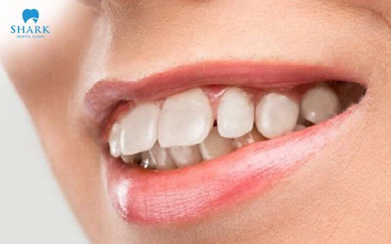 Bọc răng sứ cho răng hô nhẹ được không? Khi nào nên bọc? 6 Răng hô nhẹ có thể cải thiện bằng phương pháp bọc răng sứ khi răng chìa ra trước ở mức độ nhỏ và đi kèm các khuyết điểm về hình dáng hoặc màu sắc