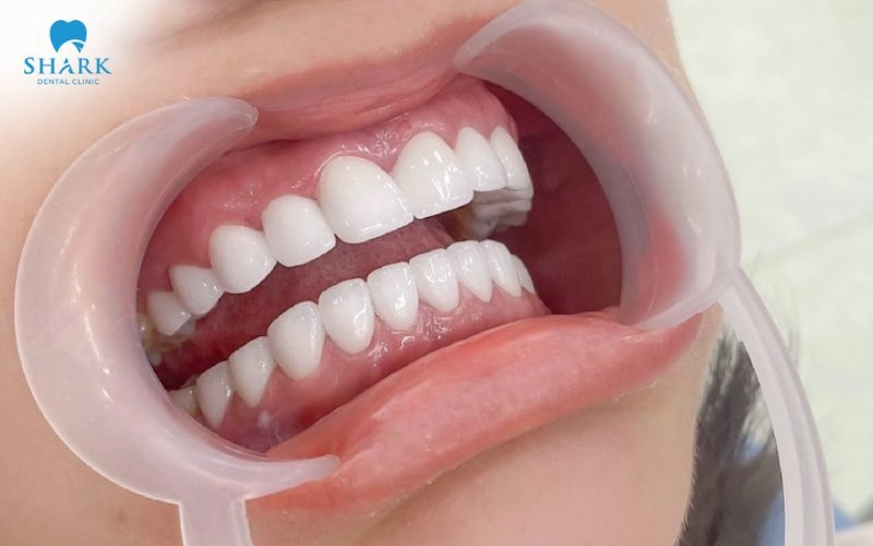 Bọc răng sứ cho răng hô nhẹ được không? Khi nào nên bọc? 7 Bọc răng sứ cho răng hô nhẹ giúp răng đều đẹp và hài hòa hơn với khuôn mặt