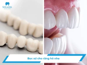 Bọc răng sứ cho răng hô nhẹ được không? Khi nào nên bọc?