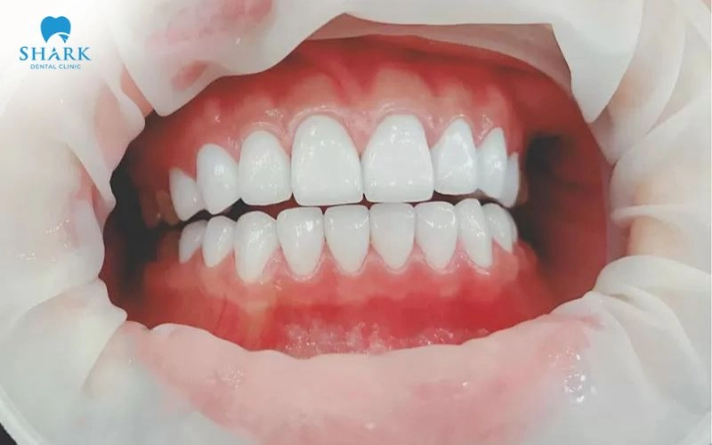 Bọc răng sứ cho răng hô nhẹ được không? Khi nào nên bọc? 10 Sau khi mão sứ đáp ứng yêu cầu, bác sĩ tiến hành gắn cố định và kiểm tra lại khớp cắn
