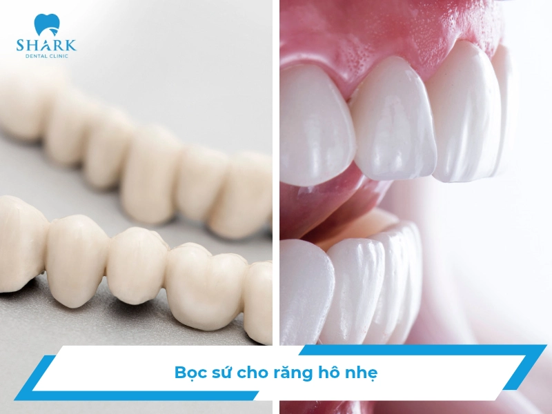 boc rang su cho rang ho nhe