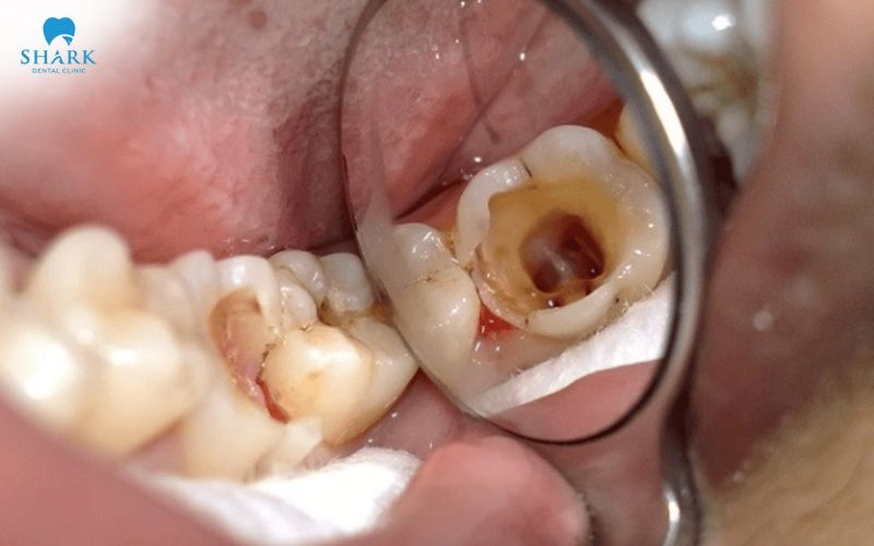 Bọc răng sứ không làm mão răng sứ bị sâu, nhưng phần răng thật bên dưới v vẫn có thể bị sâu