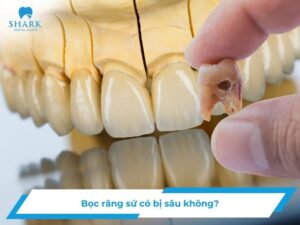 Bọc răng sứ có bị sâu không? Có gây nguy hiểm không?