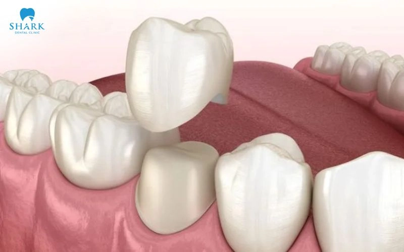 Bọc răng sứ có bị sâu không? Có gây nguy hiểm không? 10 Sau khi răng được điều trị ổn định, bác sĩ làm lại mão sứ với độ khít sát phù hợp, giúp bảo vệ phần răng thật còn lại