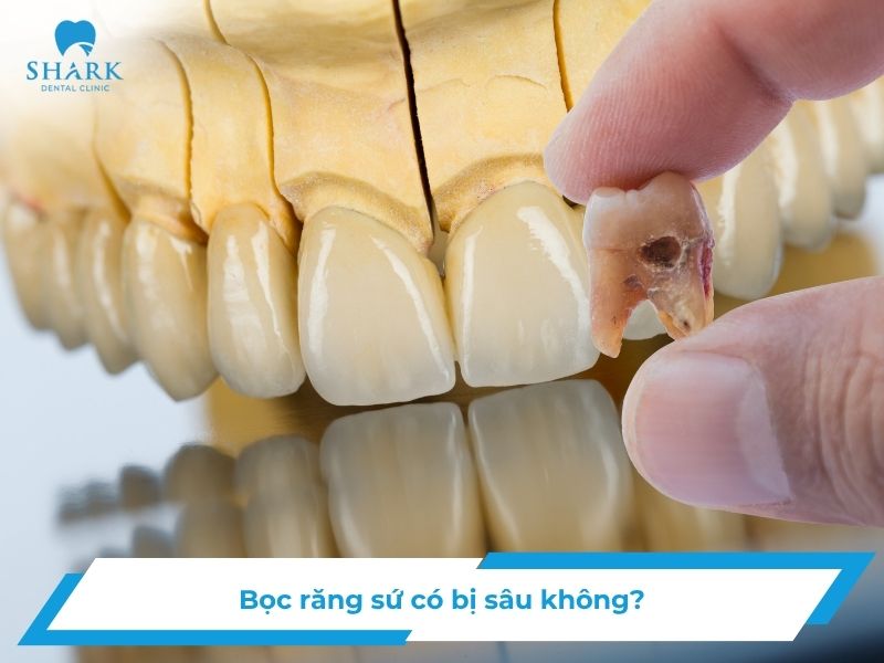 Bọc răng sứ có bị sâu không