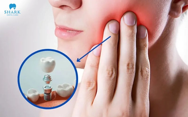 Cắm Implant bao lâu thì hết sưng? Nguyên nhân bị sưng dai dẳng 8 Trồng răng Implant bị sưng có thể xuất hiện do phản ứng tự nhiên của cơ thể trước những tác động tại vùng cấy ghép