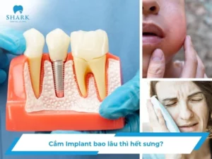 Cắm Implant bao lâu thì hết sưng? Nguyên nhân bị sưng dai dẳng
