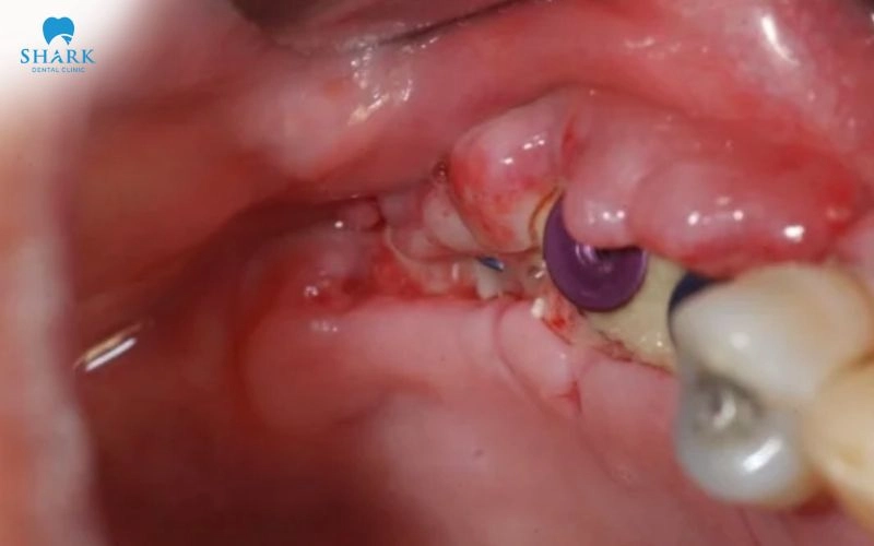 Cắm Implant bao lâu thì hết sưng? Nguyên nhân bị sưng dai dẳng 11 Sau phẫu thuật, dịch có thể tích tụ trong các mô xung quanh vùng cấy ghép, gây phù nề và cảm giác căng tức
