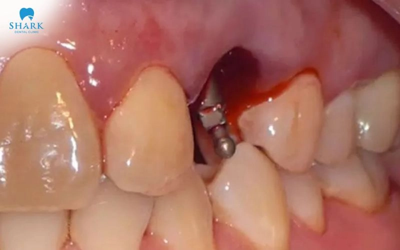Cắm Implant bao lâu thì hết sưng? Nguyên nhân bị sưng dai dẳng 12 Chảy máu nhẹ trong thời gian đầu có thể xuất hiện do sử dụng các vật liệu khâu hoặc kỹ thuật khâu không phù hợp