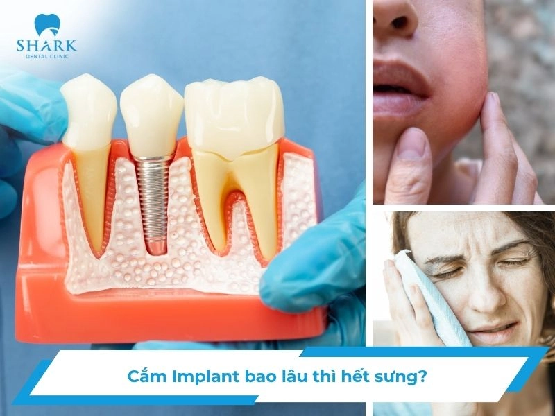 Cắm Implant bao lâu hết sưng
