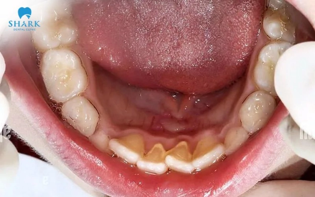 Vôi răng là lớp màng mềm chứa vi khuẩn, vụn thức ăn, theo thời gian lớp màng này cứng lại và hình thành cao răng