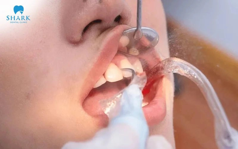 Trẻ em có thể được cạo vôi răng khi cao răng tích tụ nhiều, gây kích ứng nướu hoặc khiến việc vệ sinh răng miệng trở nên khó khăn