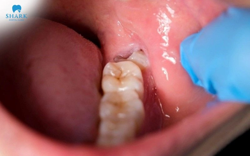 Răng khôn mọc lệch hoặc mọc ngầm là một trong những nguyên nhân dẫn đến cứng hàm sau nhổ răng khôn