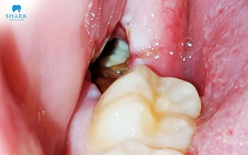 Nhiễm trùng hay viêm ổ răng khô có thể xuất hiện và khiến khít hàm sau nhổ răng khôn
