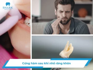 Nguyên nhân bị cứng hàm sau nhổ răng khôn và cách xử lý