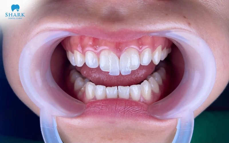 Dán sứ Veneer có bong không? Cách phòng ngừa Veneer bị rơi 6 Dán sứ Veneer có thể sẽ không bị bong hoặc vỡ nếu được thực hiện đúng kỹ thuật và sử dụng vật liệu phù hợp