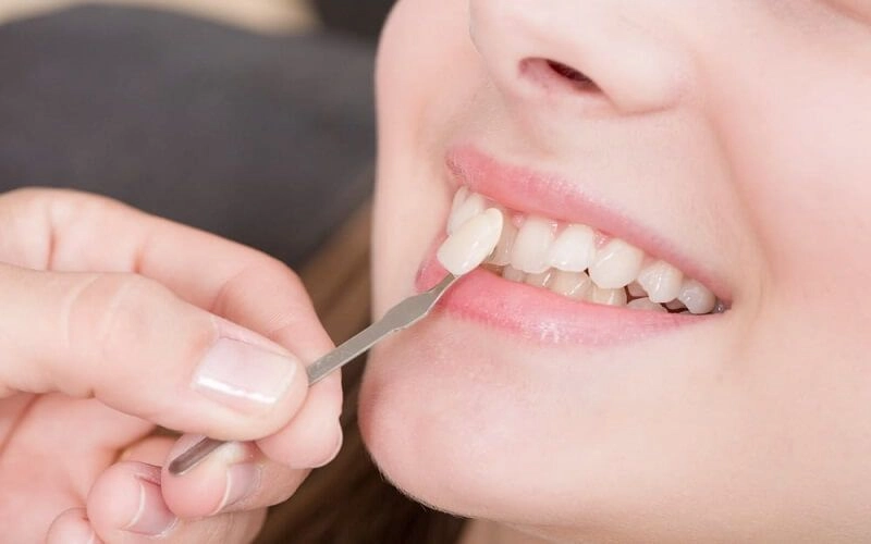 Dán sứ Veneer có bong không? Cách phòng ngừa Veneer bị rơi 8 Mặt dán Veneer bị rơi vẫn có thể dán lại nếu mặt sứ còn nguyên vẹn, không bị nứt hoặc vỡ