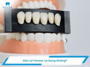 Dán sứ Veneer có bong không? Cách phòng ngừa Veneer bị rơi